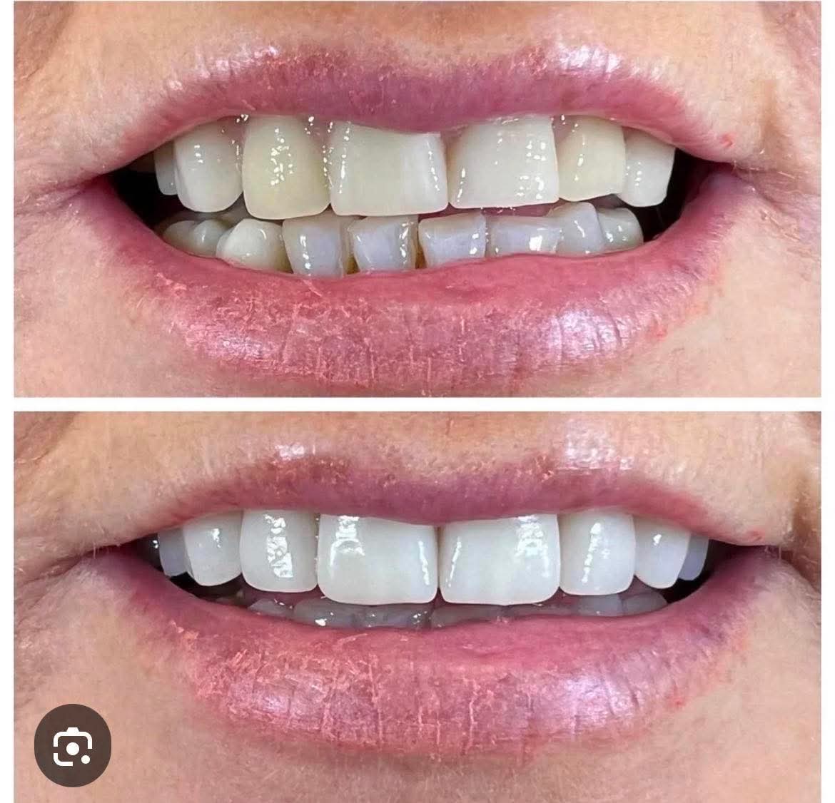 After — Apple Smile dentures